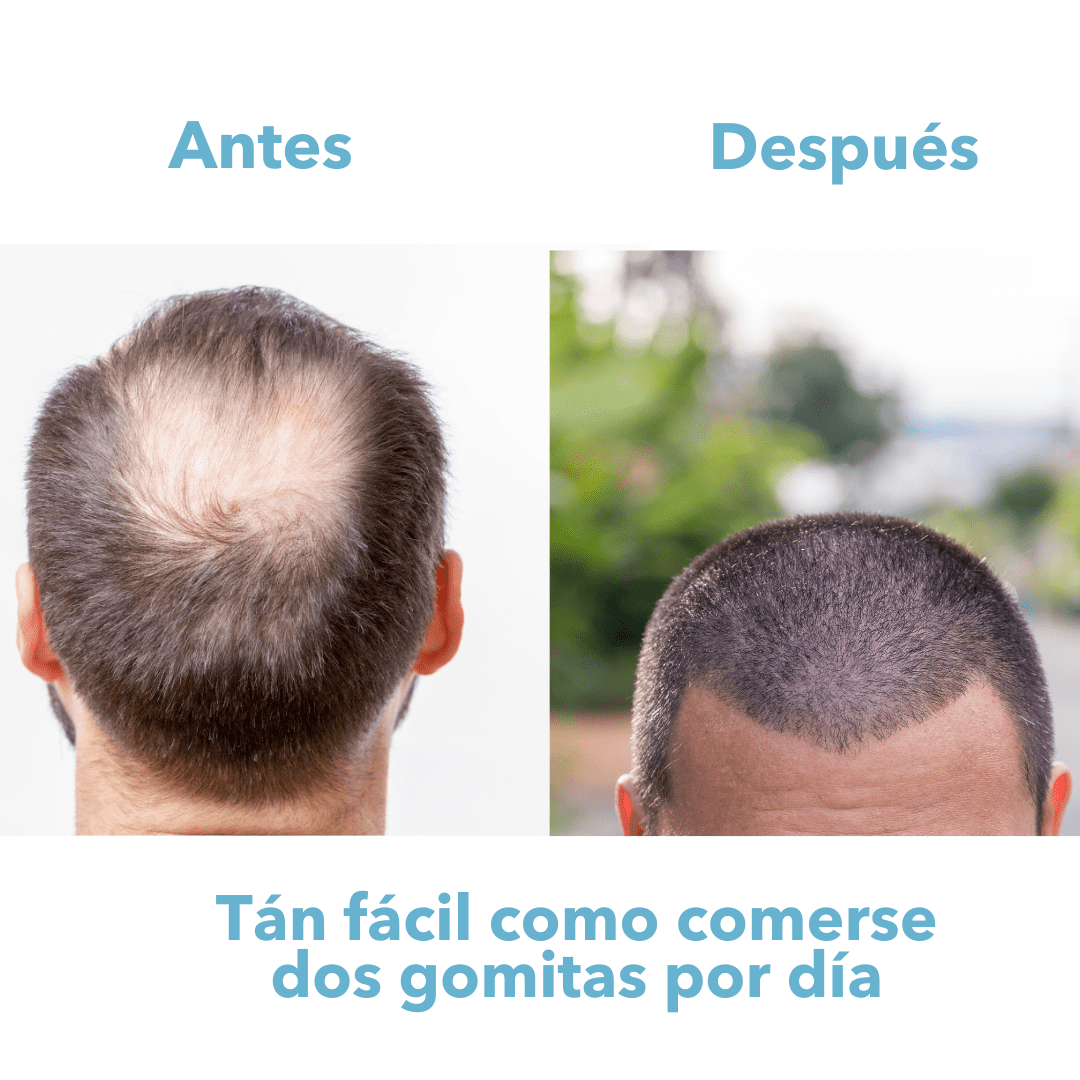 Gomitas de biotina,  Recupera tu cabello en menos de 90 días